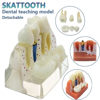 Модель зубного имплантата Модель коронки мостовидного протеза Съемная модель зубов для обучения стоматологии Демонстрационная модель зубов 1