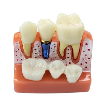 Модель зубного имплантата Модель коронки мостовидного протеза Съемная модель зубов для обучения стоматологии Демонстрационная модель зубов 2